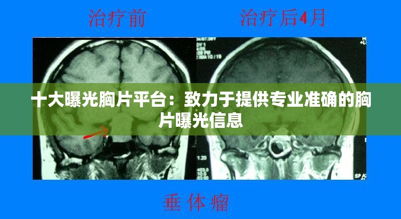 十大曝光胸片平台：致力于提供专业准确的胸片曝光信息